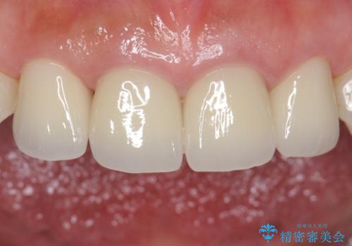 自然な前歯にしたい ジルコニアクラウンでの修復の治療後