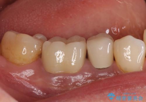 目立つ銀歯を白くしたい ジルコニアクラウンでの修復の治療後