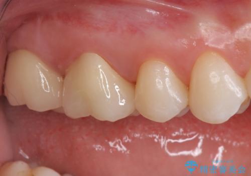 銀歯を白くしたいの治療後