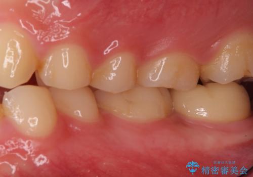 奥歯がしみる 神経を温存する治療の治療後
