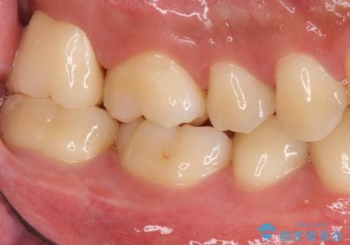 銀歯をなくしたい ジルコニアクラウンでの修復の治療後