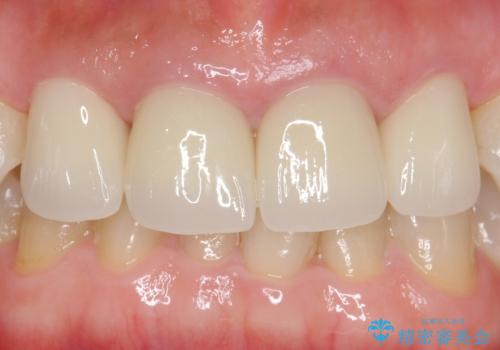 自然な前歯にしたい ジルコニアクラウンでの修復の治療後