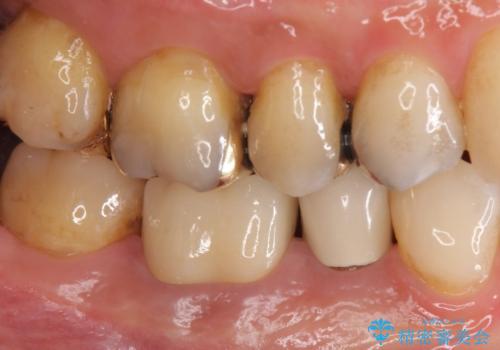 目立つ銀歯を白くしたい ジルコニアクラウンでの修復の治療後