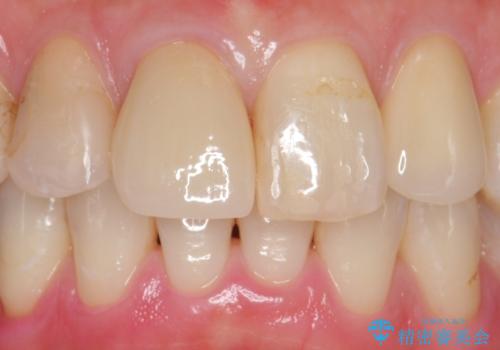 前歯を綺麗にしたい。 ジルコニアクラウンでの修復の治療後