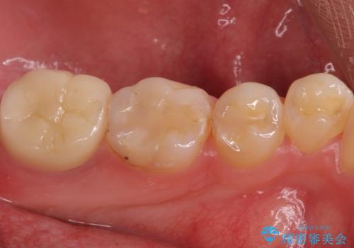 奥歯がしみる 神経を温存する治療の治療後