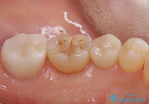 産後の虫歯治療 セラミッククラウンでの治療の治療後