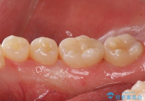 見た目にはわかりにくい奥歯の虫歯 セラミックインレーでの治療の治療後