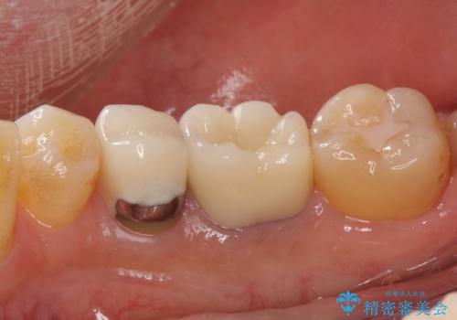 目立つ銀歯を白くしたい ジルコニアクラウンでの修復の治療後