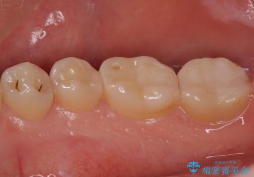 銀歯を白くしたい セラミックインレーでの治療の治療後