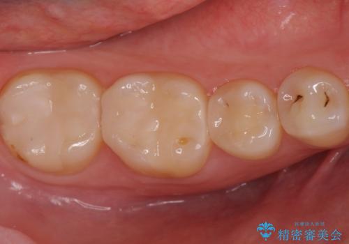 銀歯を白くしたい セラミックインレーでの治療の症例 治療後