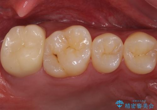 銀歯をなくしたい　ジルコニアクラウンでの修復の症例 治療後