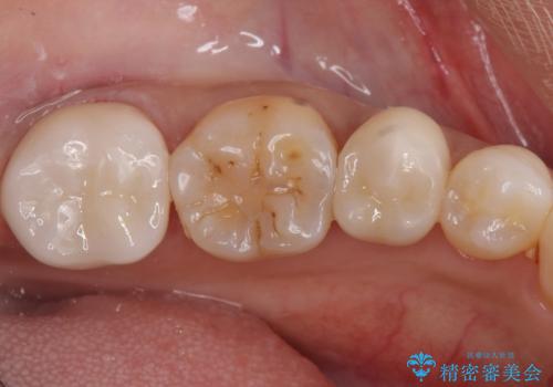 産後の虫歯治療 セラミッククラウンでの治療の治療後