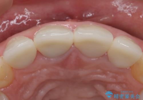 自然な前歯にしたい ジルコニアクラウンでの修復の治療後