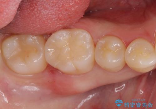 見た目にはわかりにくい奥歯の虫歯　セラミックインレーでの治療の治療後