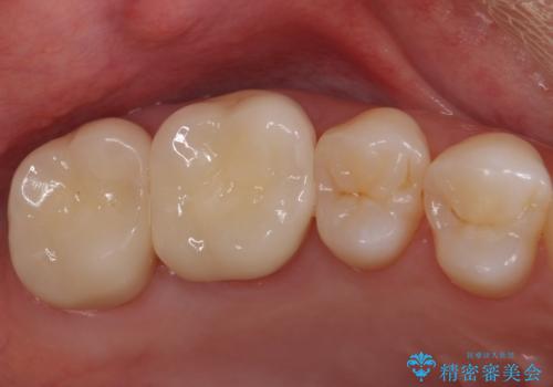 銀歯を白くしたいの症例 治療後