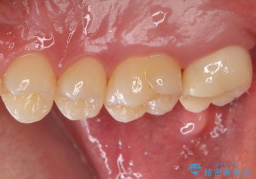 銀歯をなくしたい ジルコニアクラウンでの修復の治療後