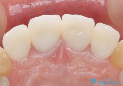 自然な前歯にしたい ジルコニアクラウンでの修復の治療後