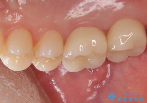銀歯を白くしたいの治療後