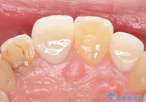 前歯を綺麗にしたい。 ジルコニアクラウンでの修復の治療後