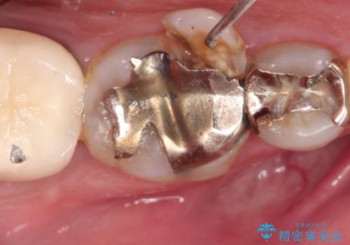 【インプラント】食事中に歯が割れた! かなり深いところまで歯が割れていたの症例 治療前