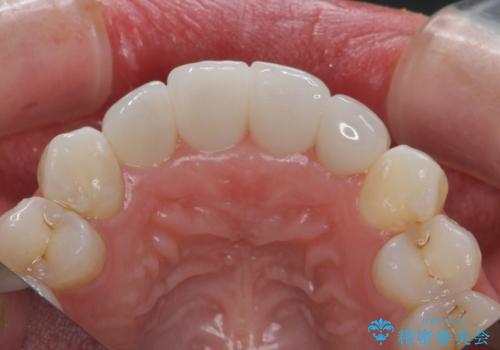 仮歯のまま放置していた前歯をセラミックにの治療後