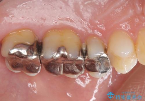 歯の神経を守る、精密な虫歯治療の実践の治療前