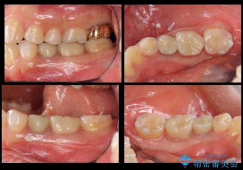 歯の高さがない 被せ物のやりなおしの治療後