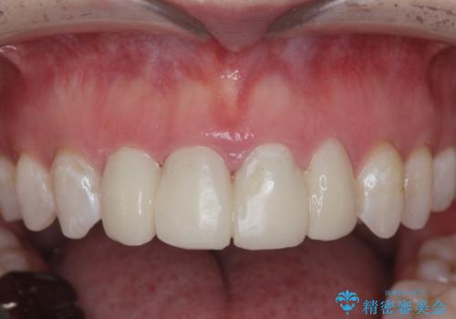 仮歯のまま放置していた前歯をセラミックにの治療前