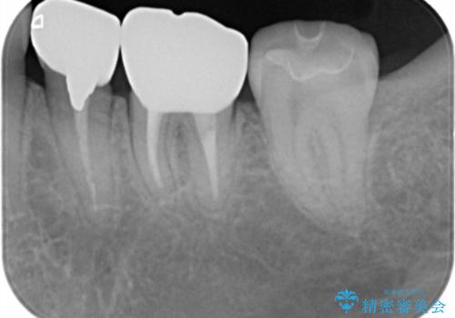 歯の高さがない 被せ物のやりなおしの治療後