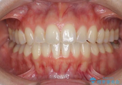 前歯のがたつきをしっかり治すマウスピース矯正の症例 治療後