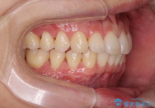 ワイヤー矯正がしたいの治療後