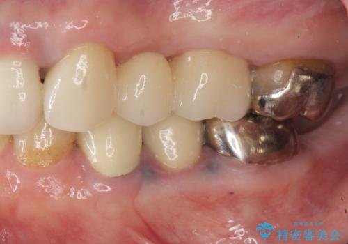 銀歯の見た目を改善、ジルコニア製セラミックブリッジの治療後