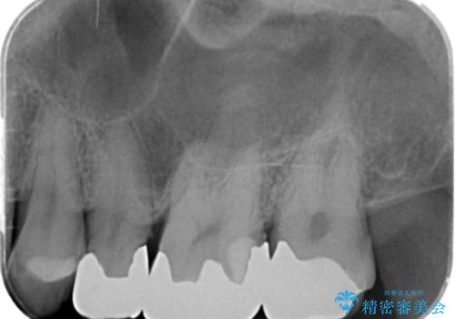歯の神経を守る、精密な虫歯治療の実践の治療前