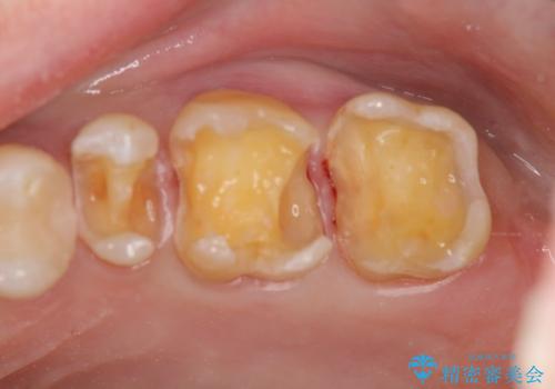 歯の神経を守る、精密な虫歯治療の実践の治療中