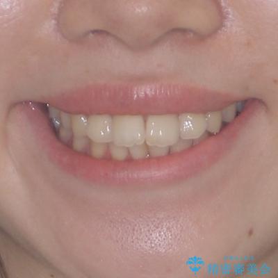 デコボコ歯列をきれいに　インビザラインによる矯正治療の治療前（顔貌）