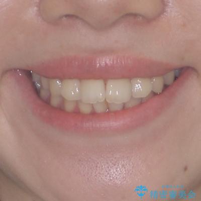 デコボコ歯列をきれいに　インビザラインによる矯正治療の治療後（顔貌）