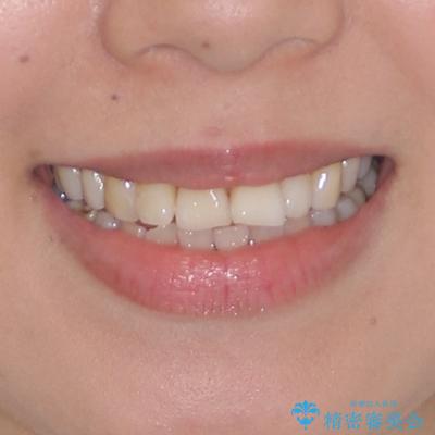 後戻りで突出した口元を引っ込めたい インビザライン矯正治療の治療前(顔貌)