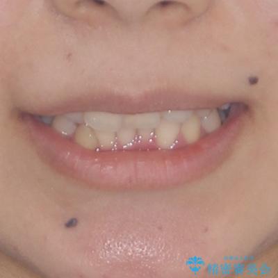 八重歯の抜歯矯正　補助装置とワイヤーを併用したインビザライン矯正治療の治療前（顔貌）