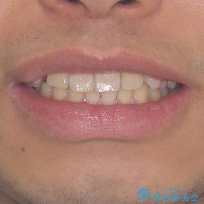 遠方からの通院 インビザライン矯正治療の治療前(顔貌)