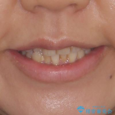 前歯のデコボコとクロスバイト インビザラインによる矯正治療の治療前(顔貌)