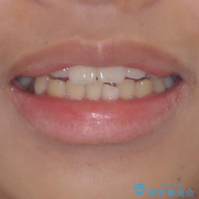 口が閉じられない 抜歯矯正で横顔の印象が劇的に変化の治療前(顔貌)