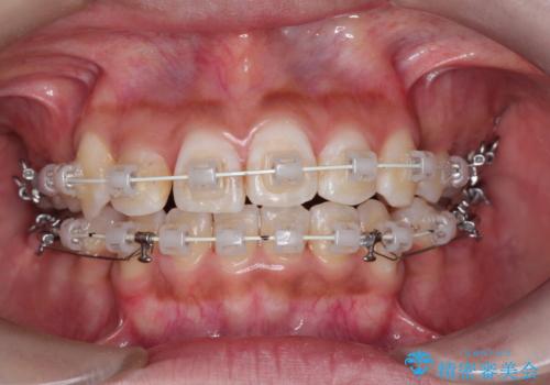 【審美装置】前歯の凸凹、抜歯矯正の治療中