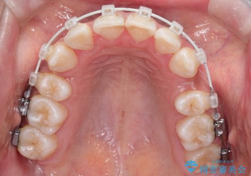【審美装置】前歯の凸凹、抜歯矯正の治療中