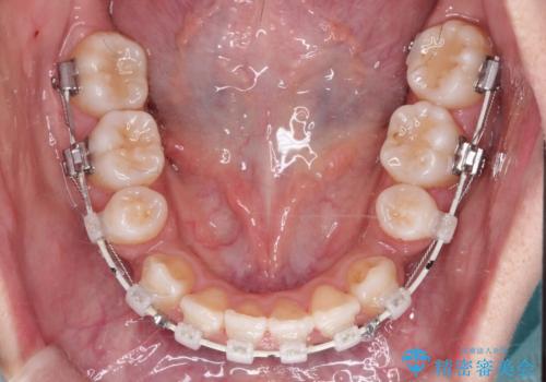 【審美装置】前歯の凸凹、抜歯矯正の治療中