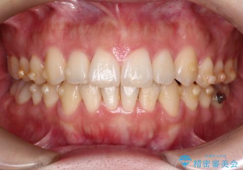 【インビザライン】前歯の凸凹を治したいの治療中