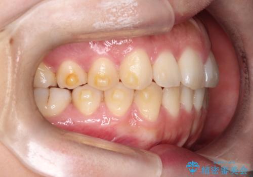 【インビザライン】前歯の凸凹を治したいの治療中