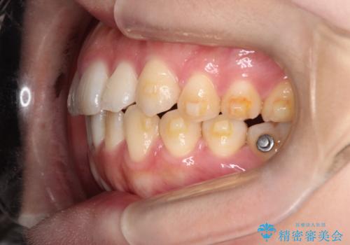 【インビザライン】前歯の凸凹を治したいの治療中