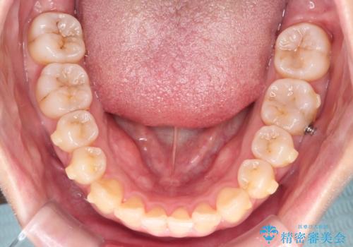 【インビザライン】前歯の凸凹を治したいの治療中