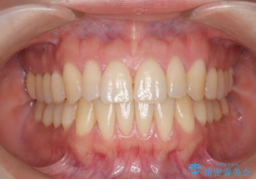 【インビザライン】反対咬合を治したいの治療後