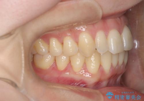 【インビザライン】反対咬合を治したいの治療後